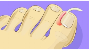 Illustration : "Plus besoin de se faire opérer pour soigner un ongle incarné ! On vous dit tout: "