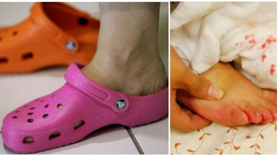 Illustration : Importante mise en garde d'un médecin contre les chaussures crocs !